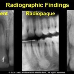 Radiolucency on dental x ray